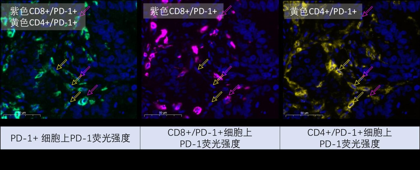 图5 PD-1+ 细胞、CD8+/PD-1+ 细胞、CD4+/PD-1+ 细胞上