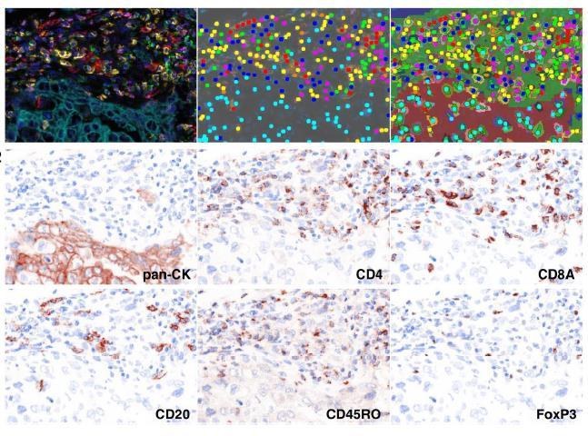 图16 NSCLC 多重荧光染色及单色拆分(pan-CK / CD4 / CD8